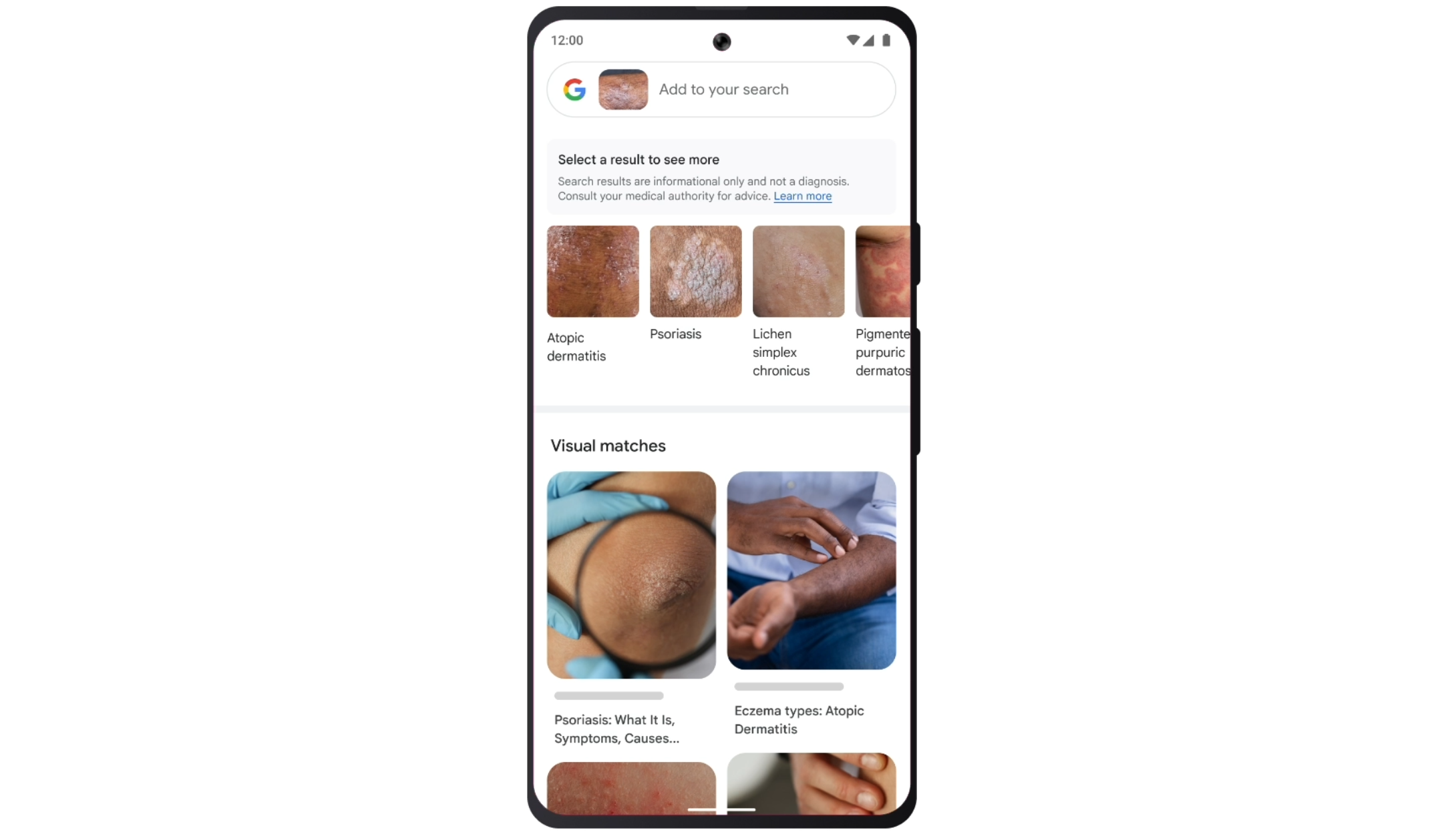 Ứng dụng Google Lens được cải tiến giờ đây có thể kiểm tra một cách không đáng tin cậy xem bạn có bị ung thư da hay không TechTimes Vietnam Ung dung Google Lens duoc cai tien gio day co TechTimes Vietnam Ứng dụng Google Lens được cải tiến giờ đây có thể kiểm tra một cách không đáng tin cậy xem bạn có bị ung thư da hay không
