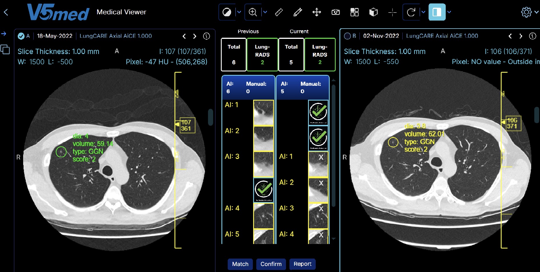 V5med Inc. dẫn đầu trong chẩn đoán hình ảnh y tế hỗ trợ trí tuệ nhân tạo với sản phẩm V5 Lung AI. Nền tảng này phân tích hình ảnh CT liều thấp (LDCT), phát hiện nốt phổi với độ nhạy lên đến 95%, đặc biệt với các nốt nhỏ (4mm–6mm) và nốt dạng kính mờ (GGO). Hệ thống tự động đánh dấu vị trí nốt, cung cấp thông tin chi tiết như đường kính, thể tích, loại nốt và điểm số Lung-RADS, đồng thời phân tích tăng trưởng nốt qua các lần chụp để hỗ trợ theo dõi dài hạn.