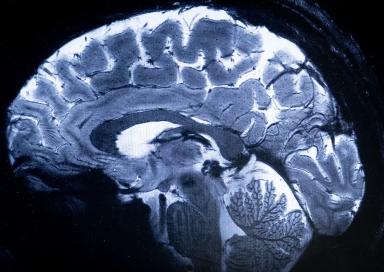 Nghiên cứu lớn nhất về quét não phát hiện dấu hiệu thiếu choline ở người mắc rối loạn lo âu TechTimes Vietnam Nghiên cứu lớn nhất về quét não phát hiện dấu hiệu thiếu choline ở người mắc rối loạn lo âu